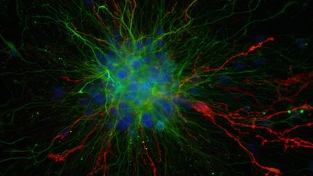 Les glioblastomes sont les tumeurs les plus fréquentes du système nerveux central Image capturée en utilisant un microscope à épifluorescence champ plein Zeiss Axioimager Z1. Inserm/Guichet, Pierre-Olivier Glioblastomes