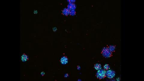 Gliome malin en culture cellulaire (spheroides). Les noyaux cellulaires sont marqués en bleus, les cellules répliquant leur ADN sont marquées en vert. Image 20X, microscope confocal ImageXpress Micro (crédit : Mehdi Touat, Caitlin Mills, HMS) Gliome malin en culture cellulaire (spheroides). Les noyaux cellulaires sont marqués en bleus, les cellules répliquant leur ADN sont marquées en vert. Image 20X, microscope confocal ImageXpress Micro (crédit : Mehdi Touat, Caitlin Mills, HMS)